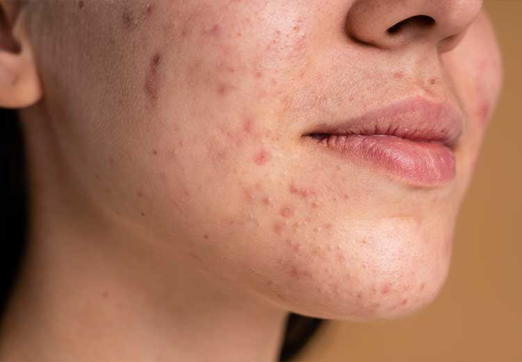 Acne-e-Cicatrizes