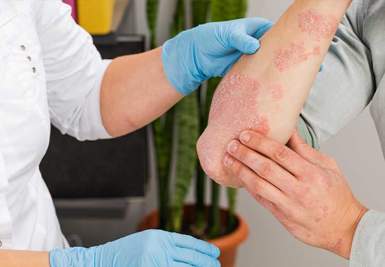 Dermatites,-Psoríase-e-Alergias